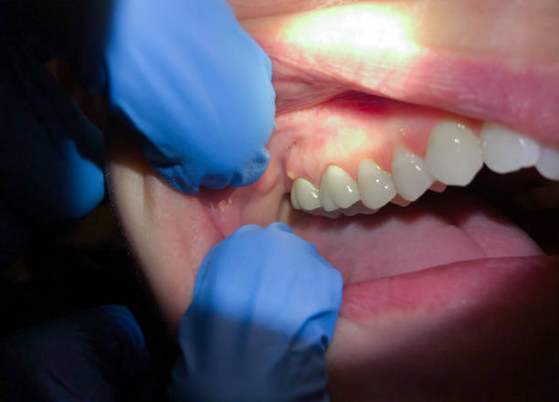 Best Broken or Chipped Tooth Repair in Audubon, NJ